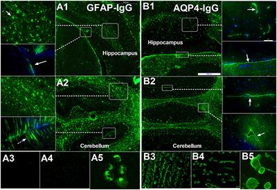 Autoimmune Glial Fibrillary Acidic Protein Astrocytopathy: A Review of the Literature